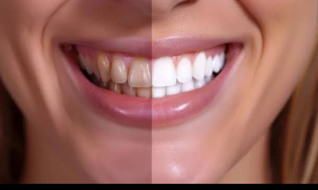 Whitening